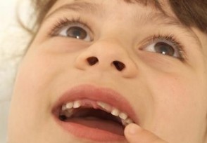 10岁娃用牙洞修复牙膏后损失6颗牙 医生说出了真相