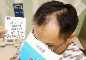 28岁程序员网购生发丸吃成肝损伤 医生提醒来了！