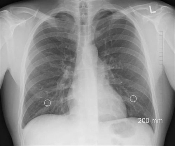 CT显示有阴影是“白肺”了吗  什么是“白肺”